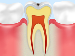 【CO：ごく初期の虫歯】