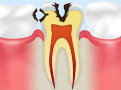【C2：象牙質の虫歯】